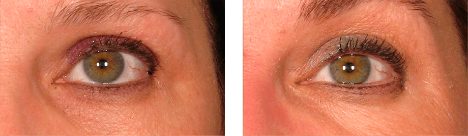 Ultherapy - Non-invasive Brow Lift