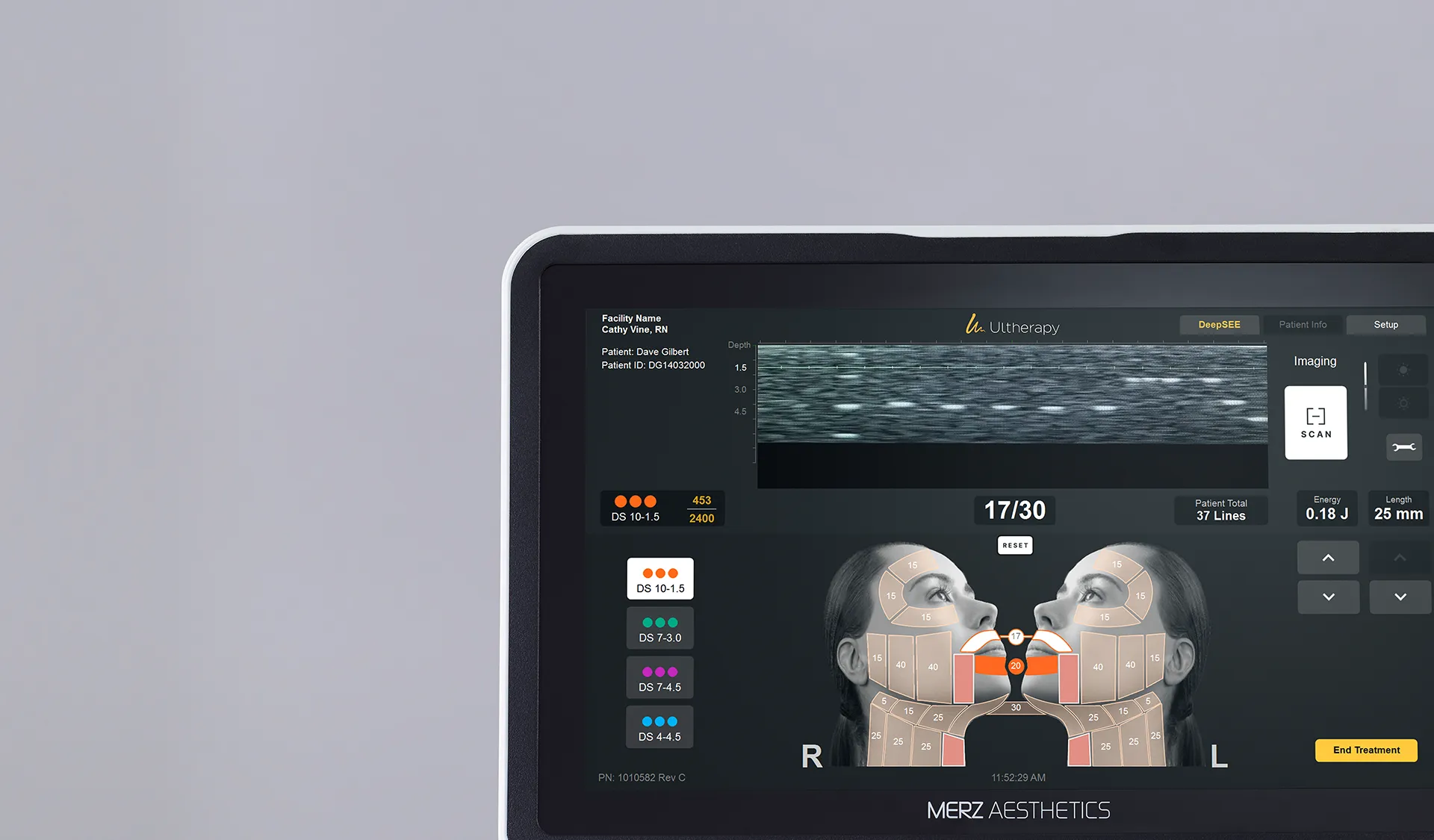 Ultherapy PRIME device control unit showing real-time imaging and treatment interface for skin lifting treatment.