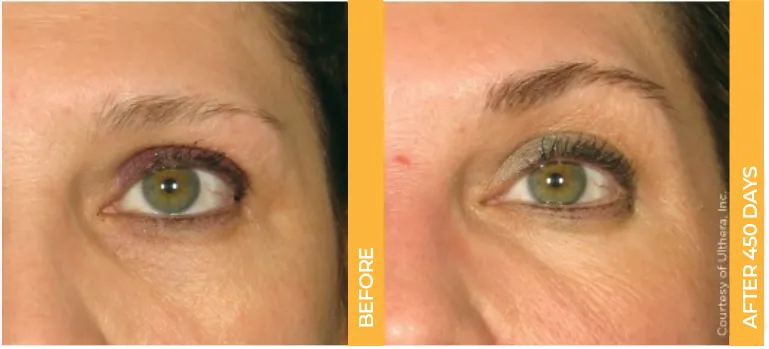 Before and after close-up of an actual Ultherapy patient’s brows, showing lifted results after 450 days.