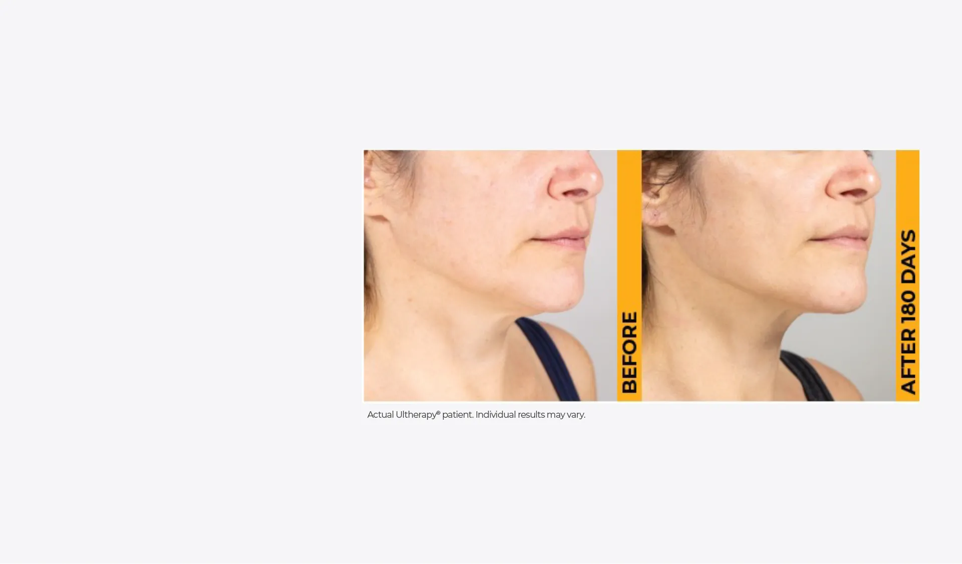 Before and after images of an actual Ultherapy patient showing proven skin lifting results after 180 days.
