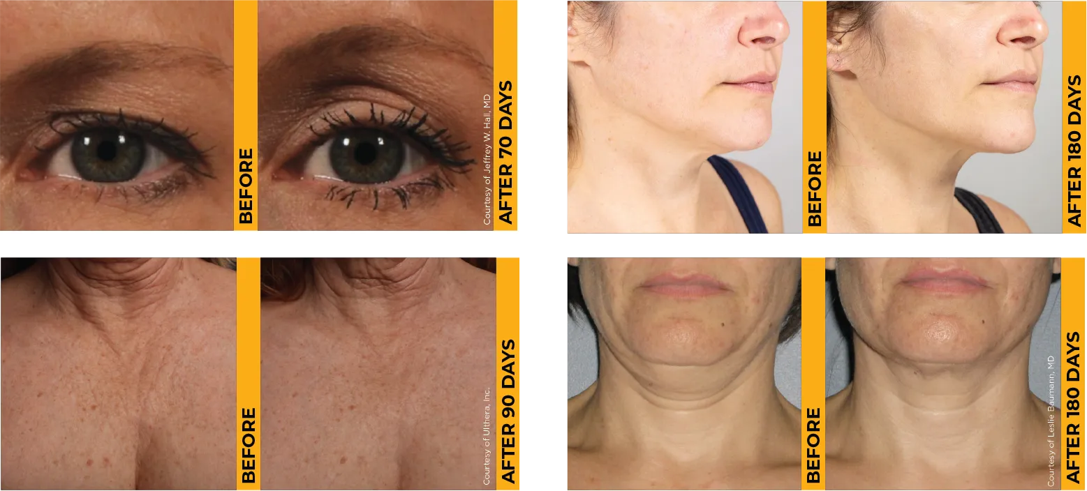 Four before-and-after photos showing proven skin lifting results on the brow, chin, décolleté, and neck.