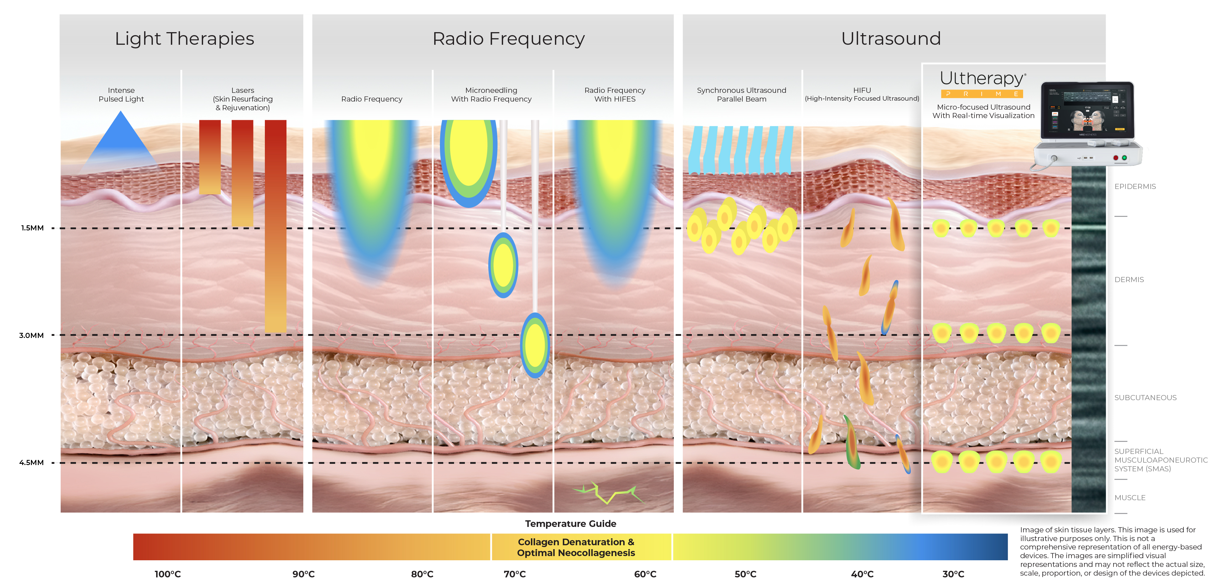 Diagram comparing Ultherapy's depth to light, radio frequency, and other ultrasound treatments across skin layers.