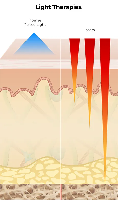 Diagram comparing light therapies to Ultherapy's deeper penetration in skin layers.
