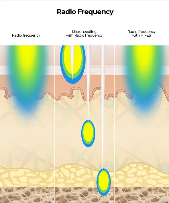 Diagram comparing radio frequency therapies to Ultherapy's deeper penetration in skin layers.