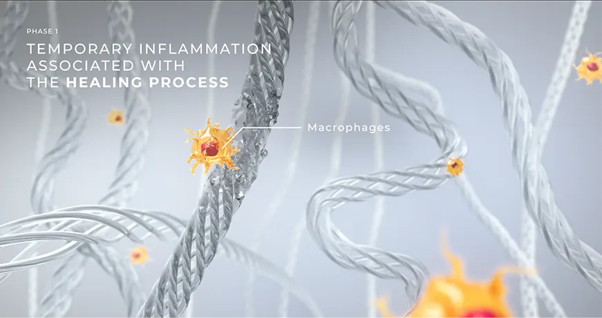 Visualization of macrophages during Phase 1 healing, showing temporary inflammation and tissue repair.