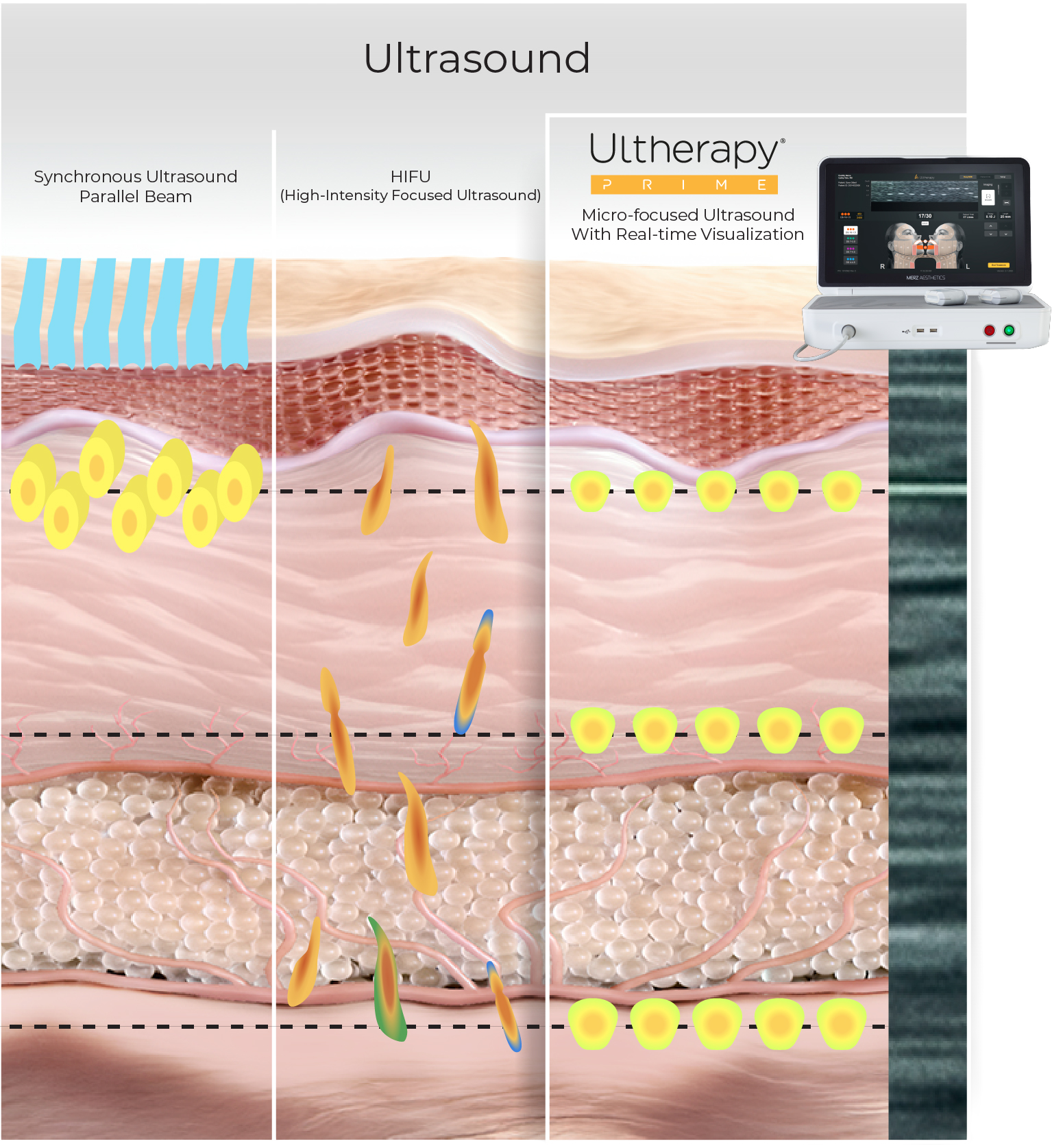 Diagram comparing other ultrasound treatments to Ultherapy's deeper penetration in skin layers.