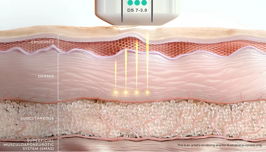 Ultherapy PRIME® diagram showing micro-focused ultrasound creating thermal coagulation points at precise skin depths.
