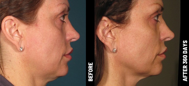 Side-by-side before and after images showing skin lifting and tightening results post-Ultherapy. Diana, 62