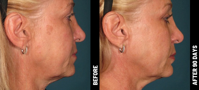 Side-by-side before and after images showing skin lifting and tightening results post-Ultherapy. 