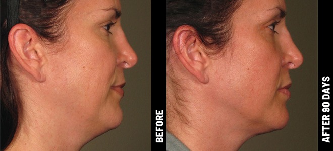 Side-by-side before and after images showing skin lifting and tightening results post-Ultherapy. 