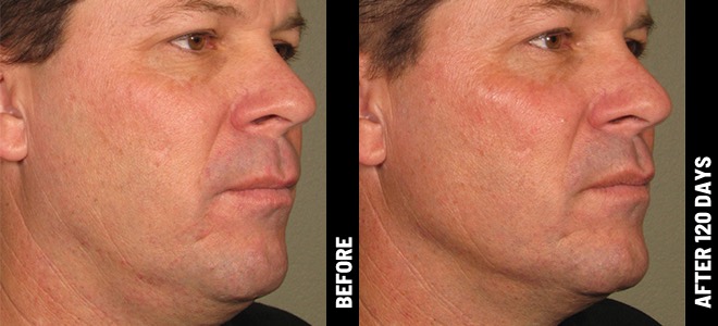 Side-by-side before and after images showing skin lifting and tightening results post-Ultherapy. 