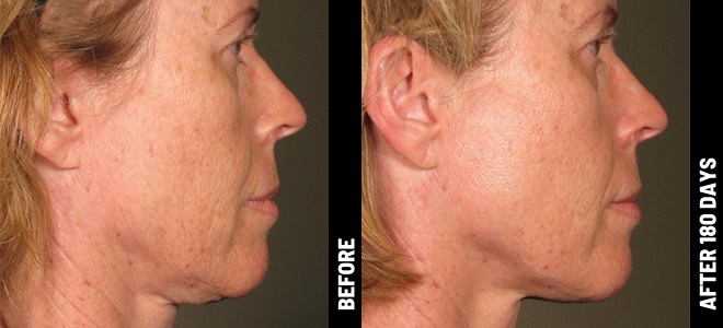 Side-by-side before and after images showing skin lifting and tightening results post-Ultherapy. 