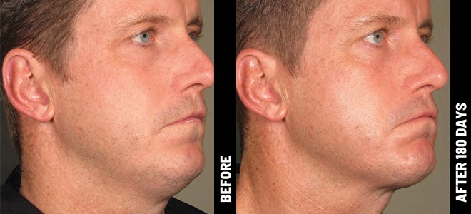 Side-by-side before and after images showing skin lifting and tightening results post-Ultherapy. 
