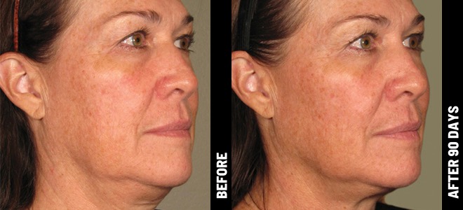 Side-by-side before and after images showing skin lifting and tightening results post-Ultherapy. 