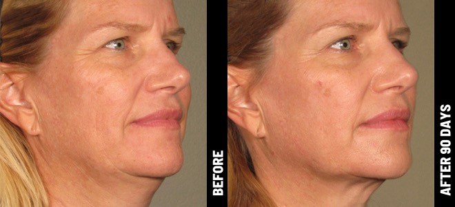 Side-by-side before and after images showing skin lifting and tightening results post-Ultherapy. 