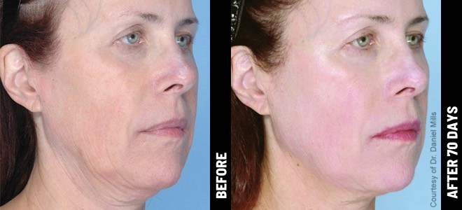 Side-by-side before and after images showing skin lifting and tightening results post-Ultherapy. 
