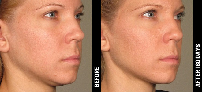Side-by-side before and after images showing skin lifting and tightening results post-Ultherapy. 