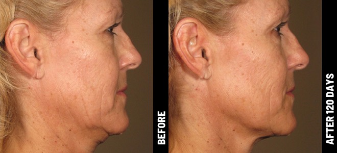 Side-by-side before and after images showing skin lifting and tightening results post-Ultherapy. 