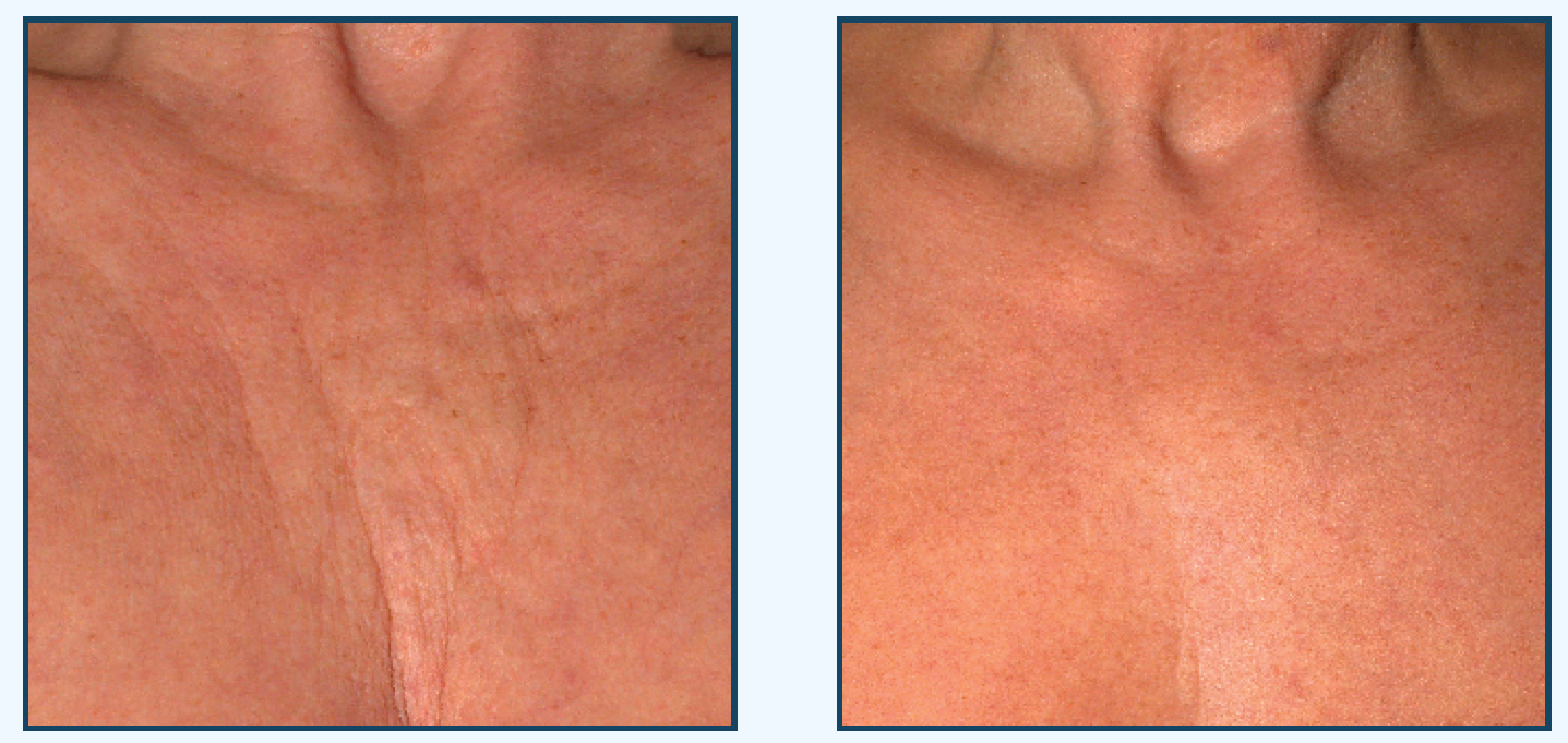 jackie-sqaure-about-hands Radiesse décolleté chest before and after