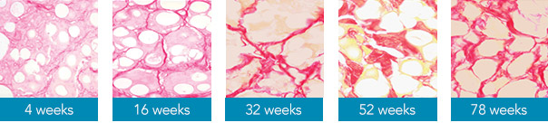Histology slides demonstrate deposition of new collagen around CaHA microspheres over an extended period of time. Collagen fibers stain red, while other tissue elements appear more yellow. RADIESSE® stimulates collagen III, which is gradually replaced by collagen I. This creates a stable organized ration of collagen I and II with structure and support, compared to collagen type I stimulation alone.<sup>4-6</sup>