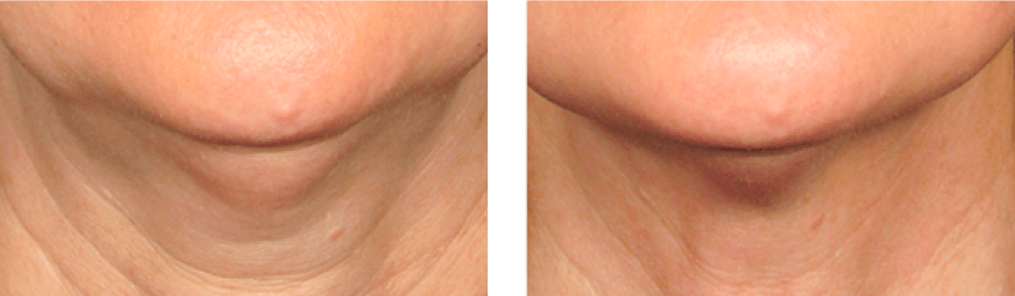 Ultherapy - Non-invasive Neck & Chin Lift