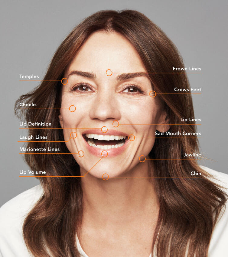 Image showing all the areas Belotero can treat on the face